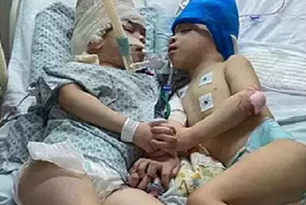 فصل توأم برأسين ملتصقين بعد عملية معقدة